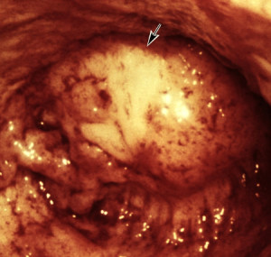 pancreas_mutilato